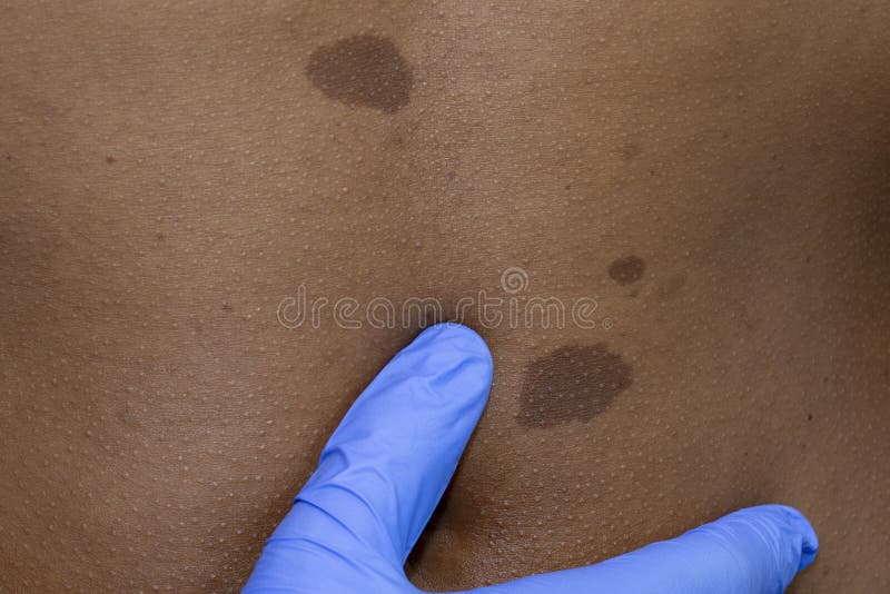 Il dermatologo medico esamina le talpe benigne in paziente africano fotografia stock Il dermatologo medico esamina le talpe benigne in paziente africano fotografia stock