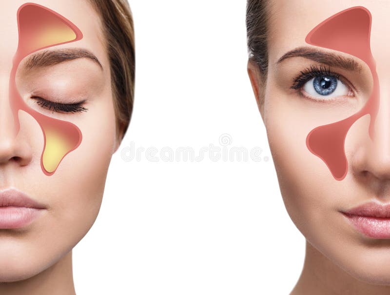 Female face shows nasal sinus with cold over white background. Dust allergies. Flu. People caught cold and allergy. Female face shows nasal sinus with cold over white background. Dust allergies. Flu. People caught cold and allergy.