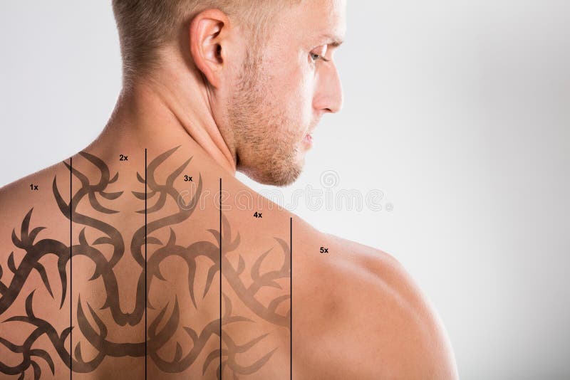 Il laser tatua la rimozione sul ` s dell'uomo indietro