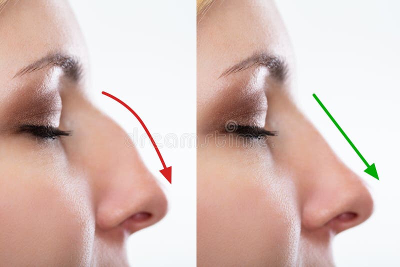 Il naso della donna prima e dopo chirurgia plastica