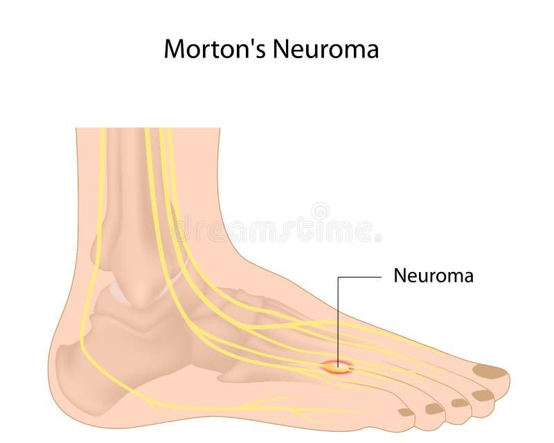 Il neuroma di Morton illustrazione vettoriale Il neuroma di Morton illustrazione vettoriale