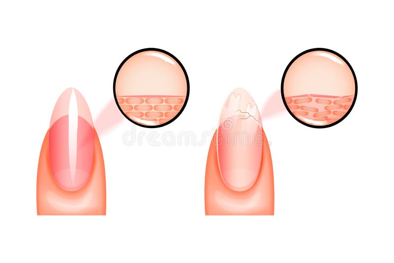 Vector illustration of nail healthy and sick under magnification. for medical and promotional publications. Vector illustration of nail healthy and sick under magnification. for medical and promotional publications