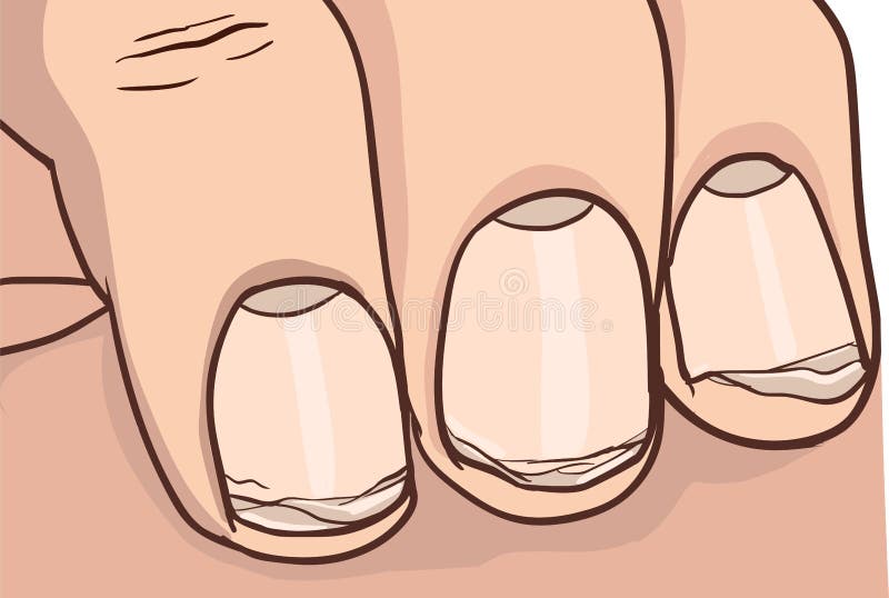 Illustration of healthy and broken nail. Illustration of healthy and broken nail.