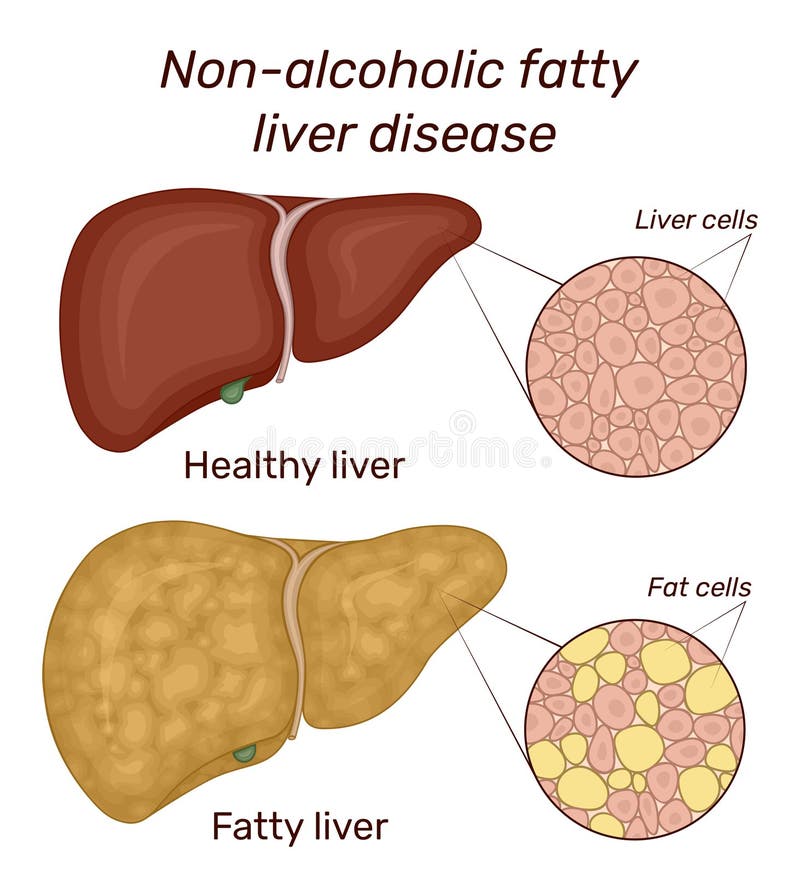 Illustratie van niet-alcoholische vetleverziekte