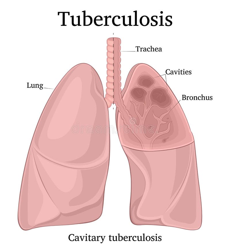 Illustration av den lung- tuberkulons vektor illustrationer Illustration av den lung- tuberkulons vektor illustrationer