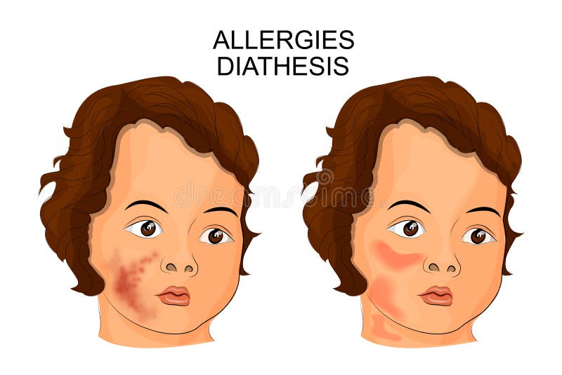 Illustration av framsidan av en barnlidandediathesis eller allergi
