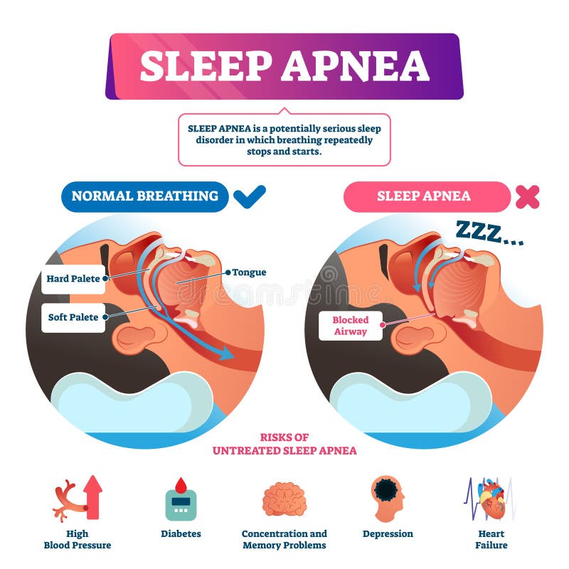 Sleep apnea vector illustration. Labeled nasal tongue blocked airway scheme. Diagram with normal and abnormal breathing comparison. Respiratory problem symptoms with list of untreated diagnosis risks. Sleep apnea vector illustration. Labeled nasal tongue blocked airway scheme. Diagram with normal and abnormal breathing comparison. Respiratory problem symptoms with list of untreated diagnosis risks.