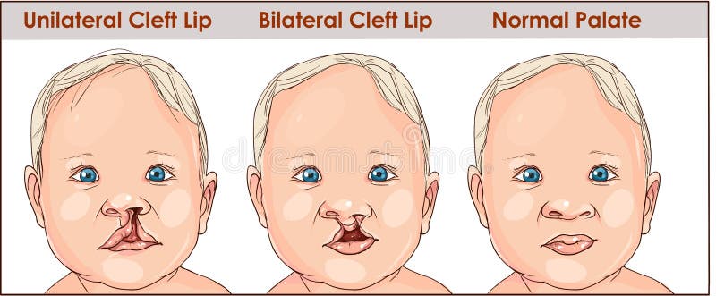 illustration of a cleft palate in a child. plastic surgery. reconstruction of the upper palate