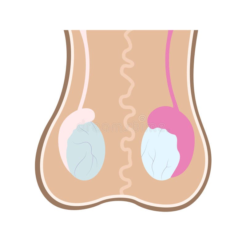 Illustration of epididimis inflamation on one of testicles compared to healthy one. Infographics in human anatomy for