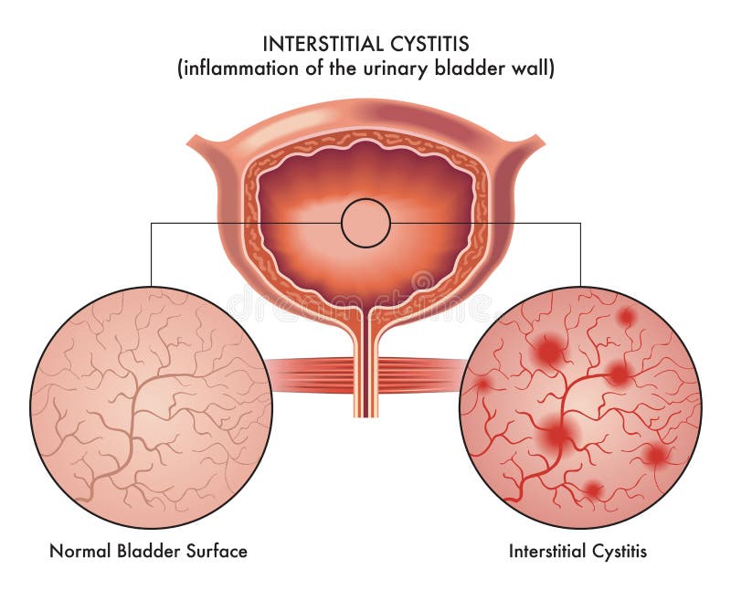 Illustration of interstitial cystitis.