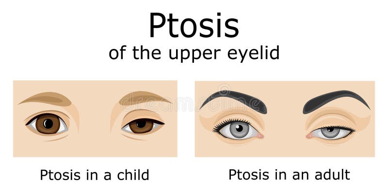 Ptosis Chart