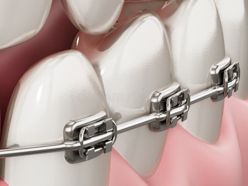 Illustration showing dental braces on straight teeth. 3D illustration royalty free illustration