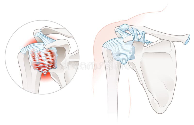Frozen Shoulder Adhesive Capsulitis Illustration. Labeled Stock