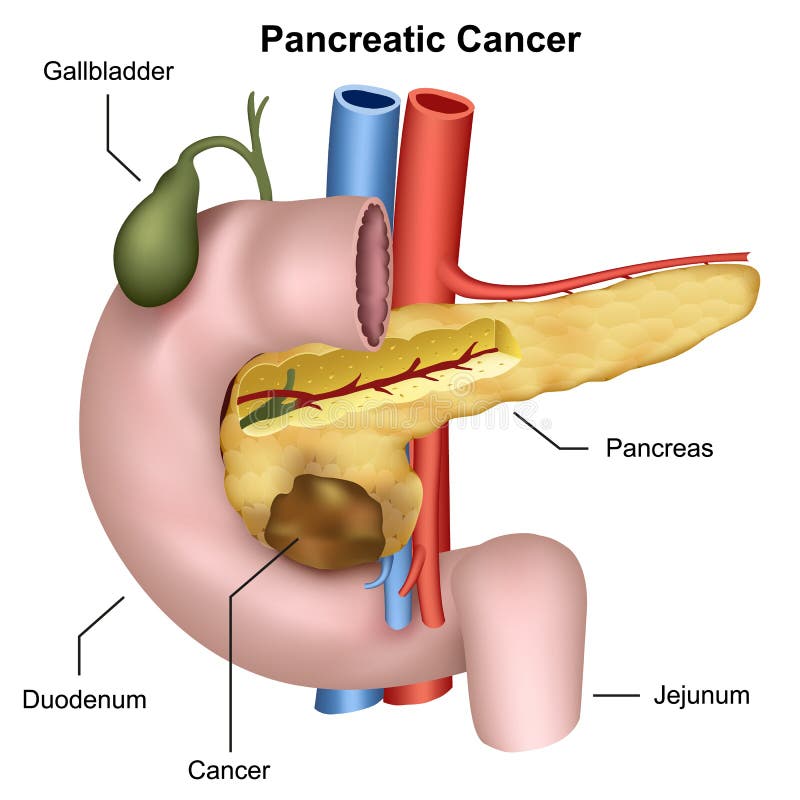 Illustrazione medica del cancro del pancreas illustrazione di stock Illustrazione medica del cancro del pancreas illustrazione di stock
