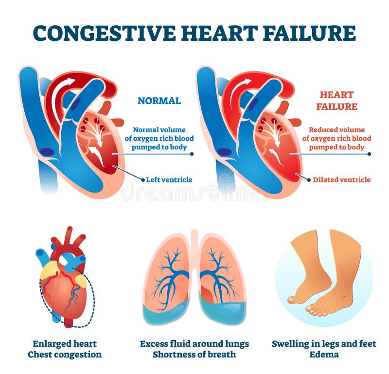 Illustrazione vettoriale di insufficienza cardiaca congestionata. sistema di comparazione medica etichettato