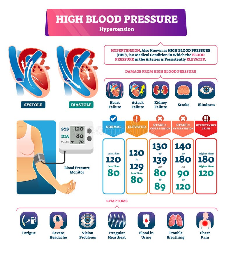 High blood pressure vector illustration. Labeled systole explanation scheme. Medical hypertension HBP condition with persistently elevated arteries. Disease symptoms and possible organs health damage. High blood pressure vector illustration. Labeled systole explanation scheme. Medical hypertension HBP condition with persistently elevated arteries. Disease symptoms and possible organs health damage.