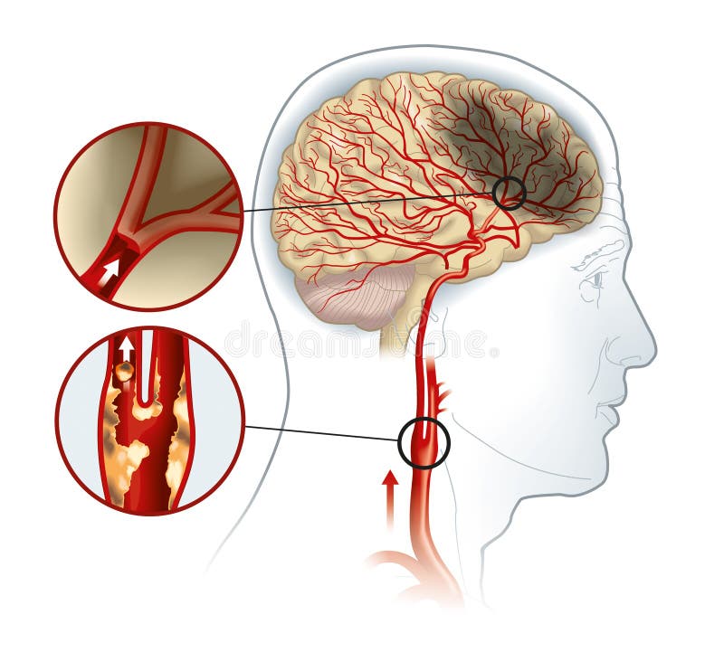 Ilustración médica de derrame cerebral