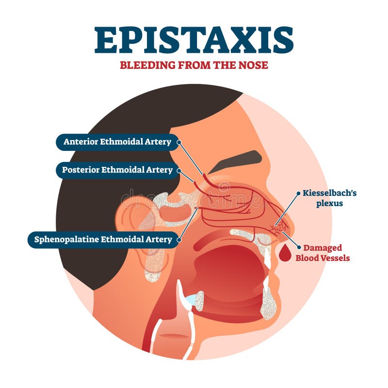 Epistaxis vector illustration. Labeled bleeding from nose explanation health scheme. Educational Inner structure with artery, vessels and kiesselbach`s plexus. Blood caused medical illness infographic. Epistaxis vector illustration. Labeled bleeding from nose explanation health scheme. Educational Inner structure with artery, vessels and kiesselbach`s plexus. Blood caused medical illness infographic