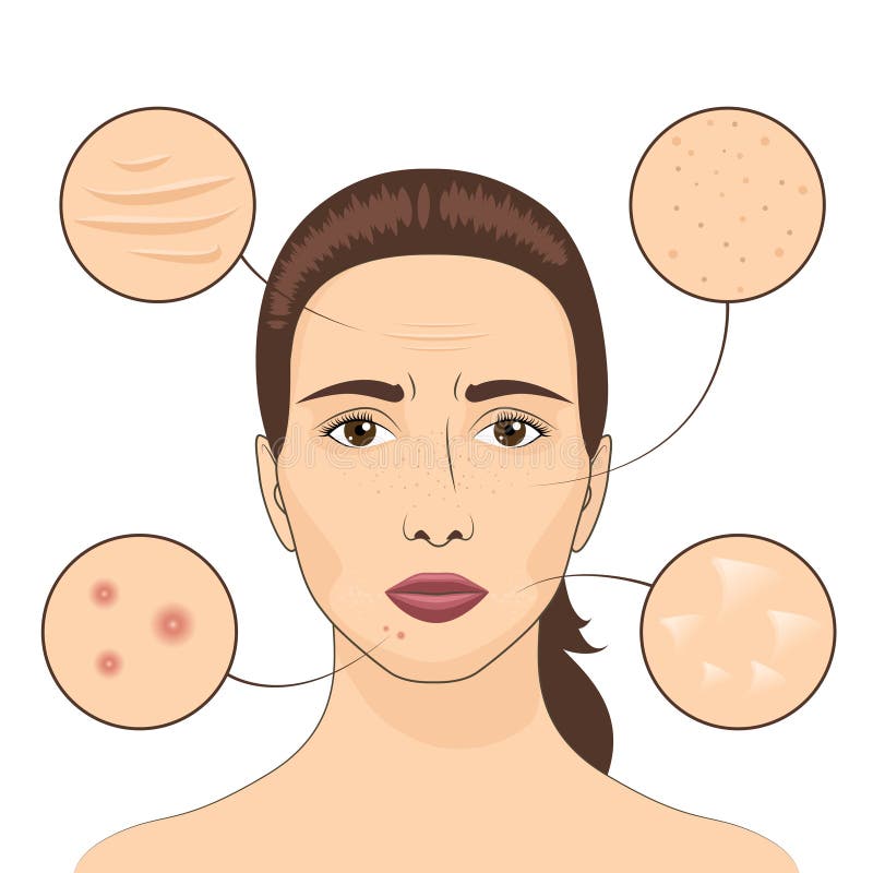 Ilustração do vetor do problema de pele da mulher Cara fêmea com áreas problemáticas das peles ilustração do vetor Ilustração do vetor do problema de pele da mulher Cara fêmea com áreas problemáticas das peles ilustração do vetor