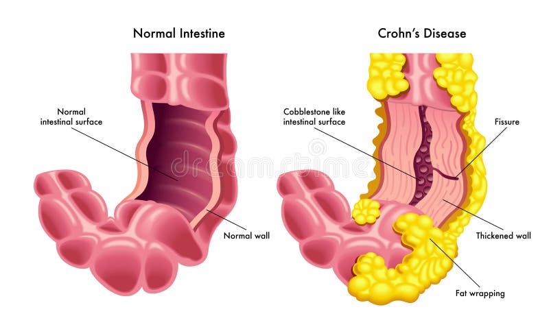 Ilustração do vetor do intestino com doença de Crohns ilustração royalty free Ilustração do vetor do intestino com doença de Crohns ilustração royalty free