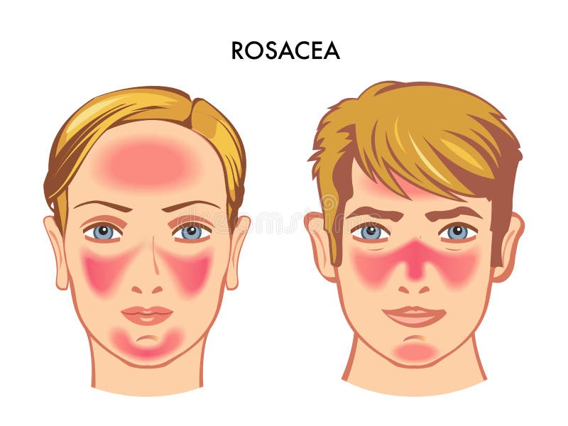 Ilustração médica de Rosacea na cara ilustração royalty free Ilustração médica de Rosacea na cara ilustração royalty free