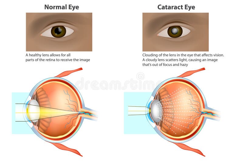 Ilustração médica de um olho normal e de um olho com uma catarata, ilustração royalty free Ilustração médica de um olho normal e de um olho com uma catarata, ilustração royalty free
