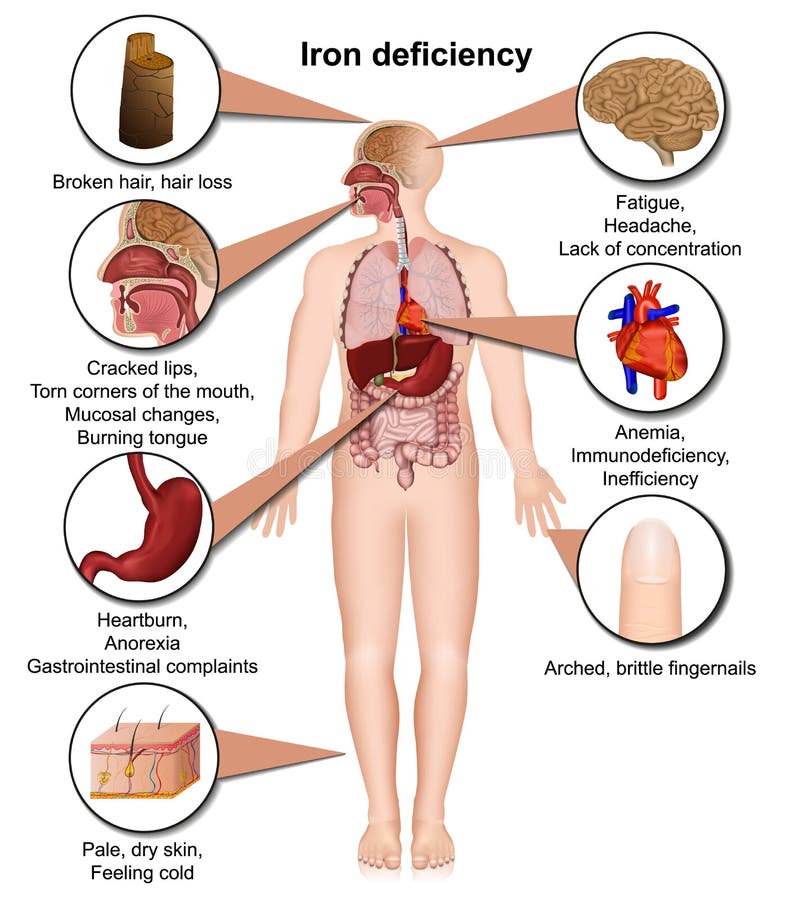 Ilustração médica do vetor do corpo 3d da deficiência de ferro isolada no fundo branco ilustração do vetor
