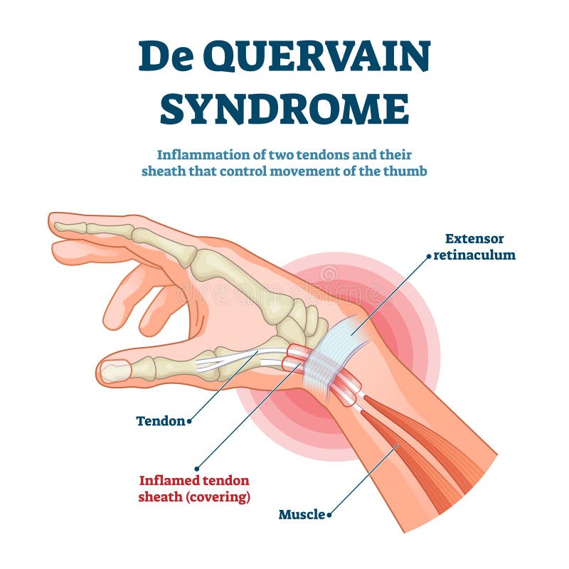 De Quervain syndrome vector illustration. Labeled thumb inflammation scheme. Painful disease diagnosis anatomical explanation. Hand tendon sheath covering pathology diagram. Chronic health problem. De Quervain syndrome vector illustration. Labeled thumb inflammation scheme. Painful disease diagnosis anatomical explanation. Hand tendon sheath covering pathology diagram. Chronic health problem.