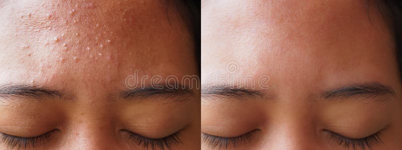 Obraz před a po akné obličejový léčba na z mladý asijský žena.