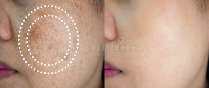 Image before and after spot melasma pigmentation skin facial treatment on face asian woman. Problem skincare and health concept.