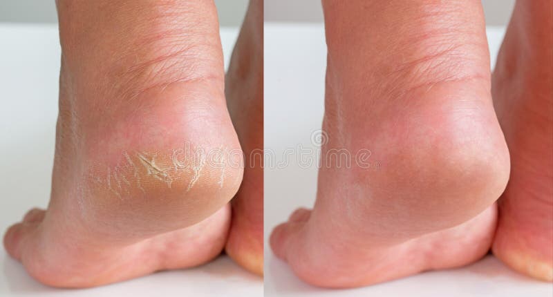 Image Before And After Treatment Of Dry Heels Cracks Skin Dehydrated Skin On Heels Of Female 
