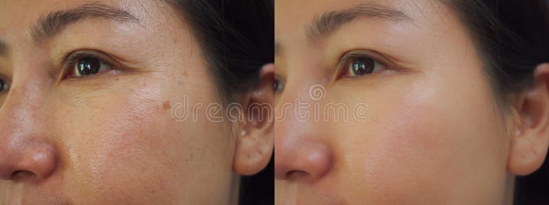 1 6 Dark Spot Face Photos Free Royalty Free Stock Photos From Dreamstime 1 6 Dark Spot Face Photos Free Royalty Free Stock Photos From Dreamstime