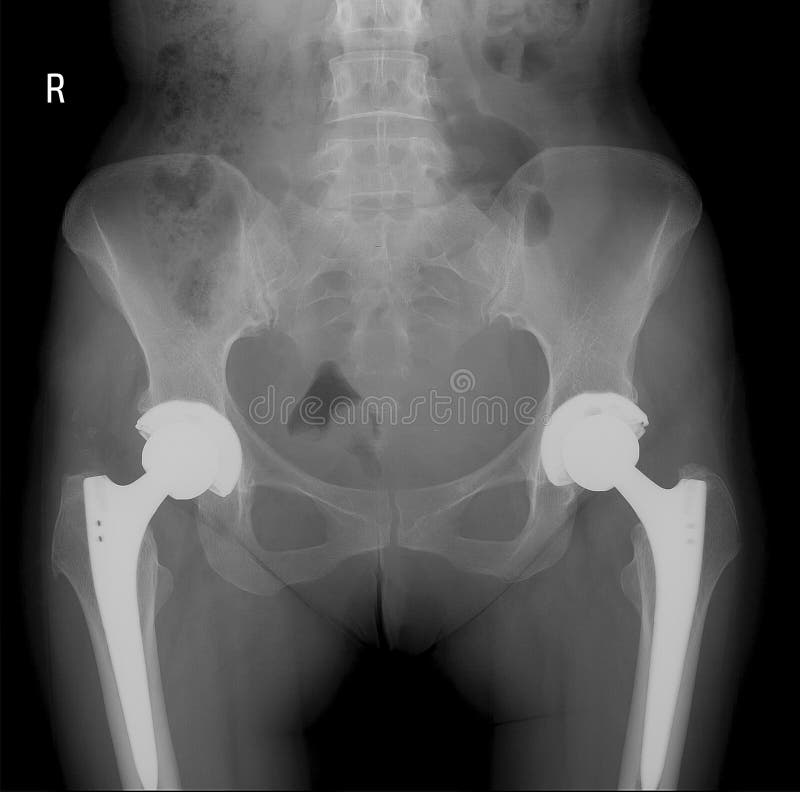 Imagem da varredura do raio X de articulações da bacia com cabeça e os parafusos ortopédicos do implante da substituição da artic fotografia de stock Imagem da varredura do raio X de articulações da bacia com cabeça e os parafusos ortopédicos do implante da substituição da artic fotografia de stock