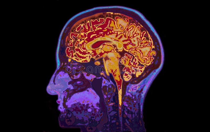 Imagem de MRI do cérebro mostrando principal
