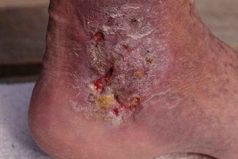 Imagem médica: Celulite da infecção foto de stock Imagem médica: Celulite da infecção foto de stock