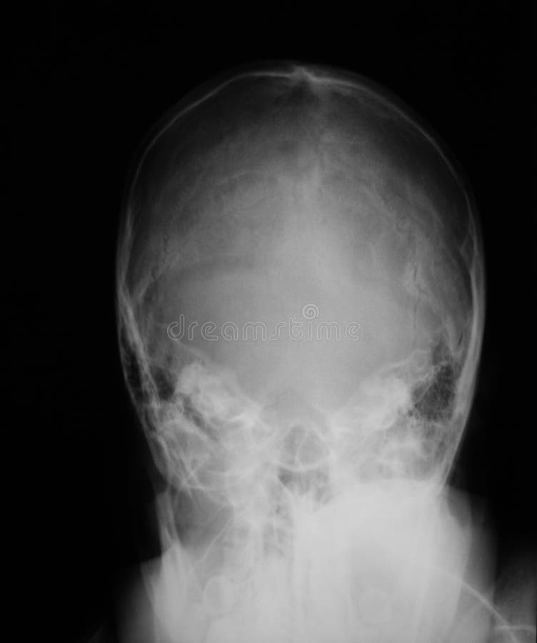 imagen del cráneo opinión de la radiografía del ap foto de archivo