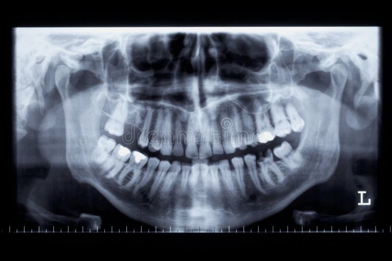 Imagen de la radiografía del panorama de una quijada humana