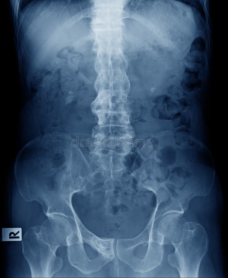 Imagen de la radiografía del spondylitis ankylosing de la demostración del viejo hombre o del spi de bambú foto de archivo libre de regalías Imagen de la radiografía del spondylitis ankylosing de la demostración del viejo hombre o del spi de bambú foto de archivo libre de regalías