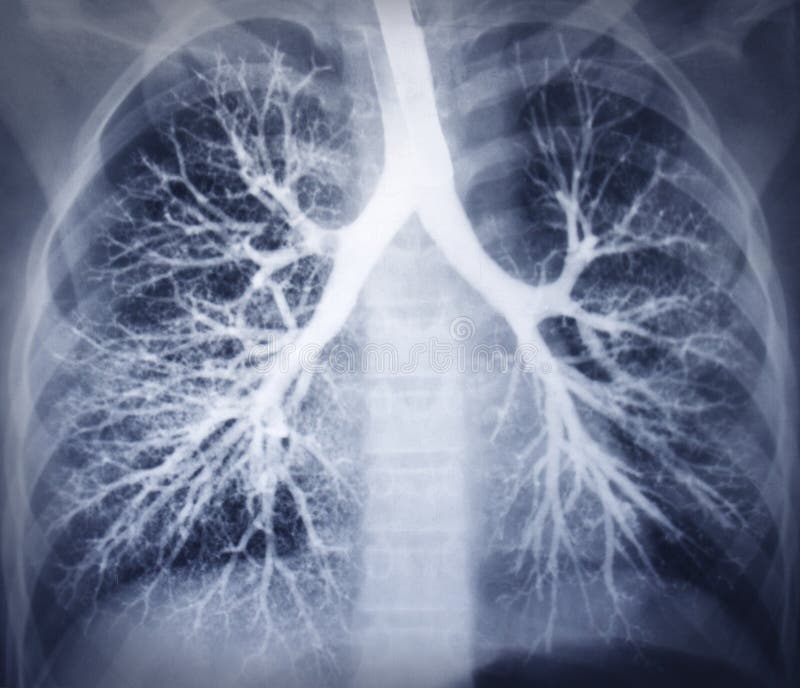 Imagen del Bronchoscopy. Radiografía del pecho. Pulmones sanos