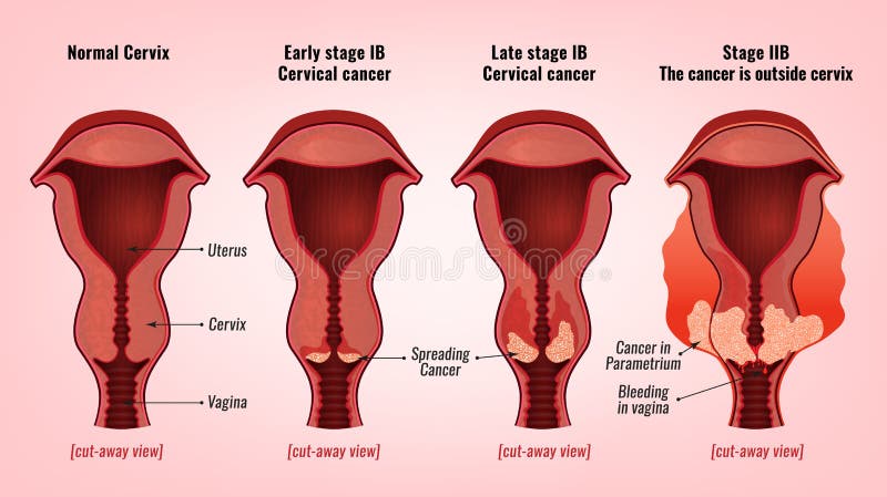 Imagen del cáncer de cuello del útero libre illustration Imagen del cáncer de cuello del útero libre illustration