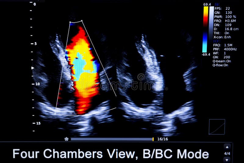 Immagine Colourful del monitor di ultrasuono del cuore di homan immagini stock Immagine Colourful del monitor di ultrasuono del cuore di homan immagini stock