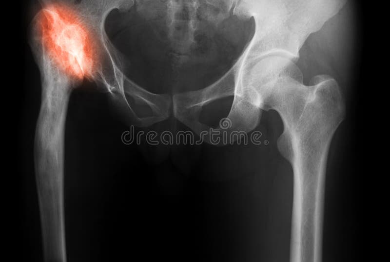Immagine dei raggi x degli entrambi anca