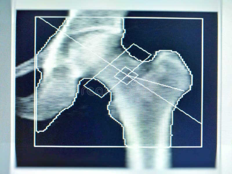 Immagine morbida e confusa: densità medica dell'osso iliaco di immagine dell'esame speciale su fondo bianco r fotografia stock libera da diritti Immagine morbida e confusa: densità medica dell'osso iliaco di immagine dell'esame speciale su fondo bianco r fotografia stock libera da diritti