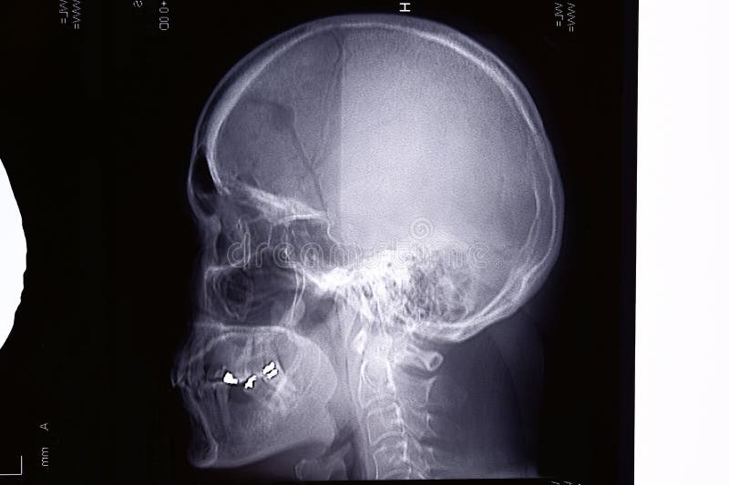 Ematoma Subdurale Cronico Fotografia Stock Immagine Di Neurochirurgia