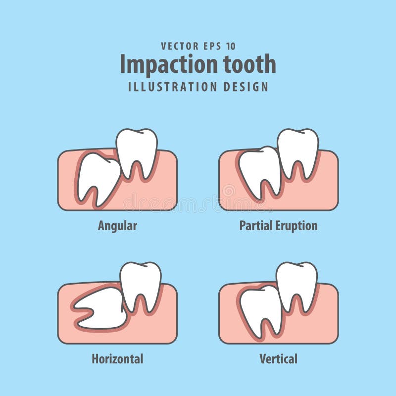 Impaction tooth illustration vector on blue background. Dental royalty free illustration