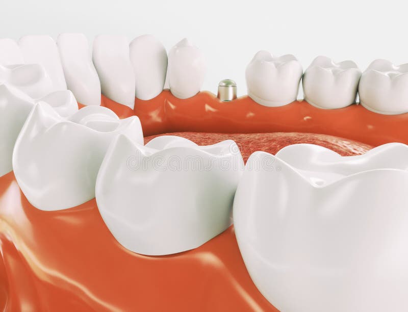 Implant dentaire - série 3 de 3 - rendu 3d photographie stock Implant dentaire - série 3 de 3 - rendu 3d photographie stock