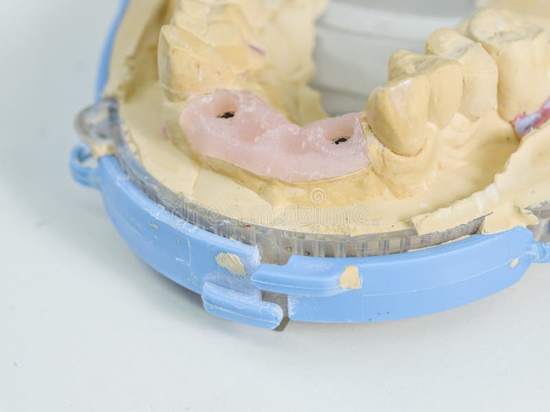 Implant Replica in a Cast Mold Dental Stock Photo Image of implant