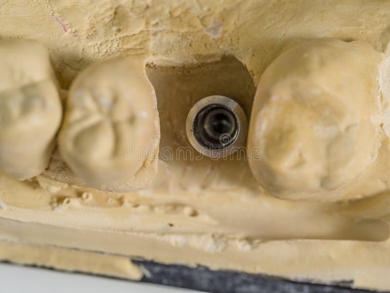 Implant Replica in a Cast Mold Dental Stock Image Image of technician
