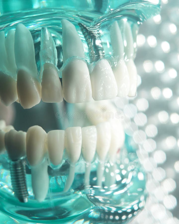 Dentists dental teeth teaching model showing each tooth, gum, root, implant, decay, plaque and enamel. Dentists dental teeth teaching model showing each tooth, gum, root, implant, decay, plaque and enamel.