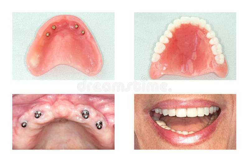 Implante dental del mandíbula superior